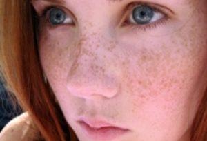 Facial Dark Spots