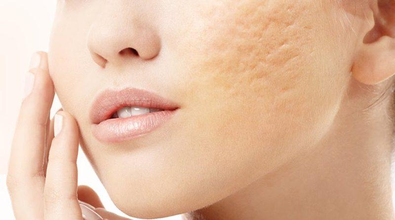 Cara Menghilangkan Jerawat dengan Langkah Cepat Secara Alami