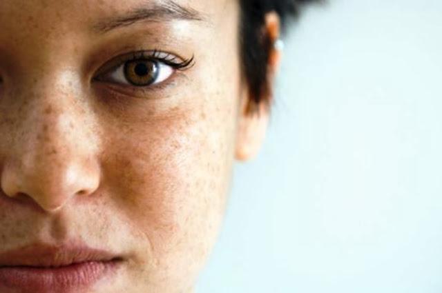 flek hitam di wajah ini cara menghilangkannya